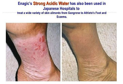 testimoni eksim eczema