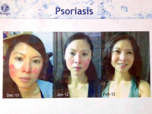 testimoni masalah kulit jerawat psoriasis kangen water