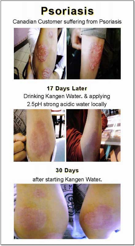 testimoni psoriasis gatal kulit